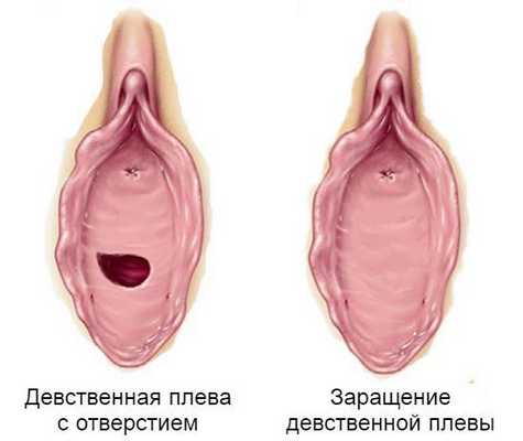 Атрезия девственной плевы