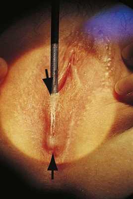 Введение зонда в карман, образованный синехиями