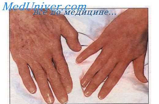 признаки анемии