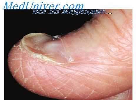 признаки анемии