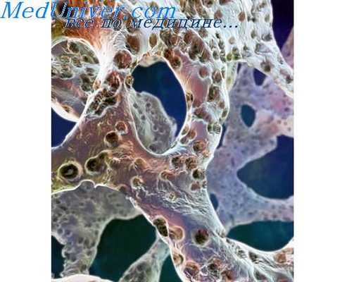 выявление постклимактерического остеопороза