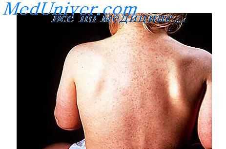 выявление краснухи