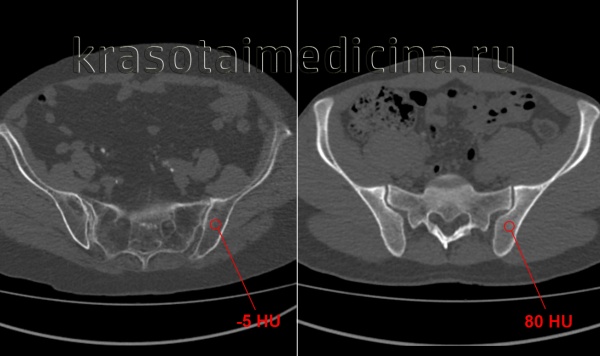 Постменопаузальный остеопороз