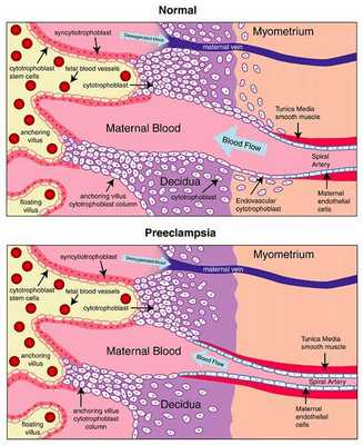 преэклампсия на схеме