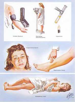 преэклампсия