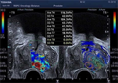 ultrazvukovoe issledovanie s elastografiej 01