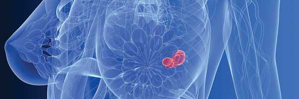 Скрининг рака молочной железы