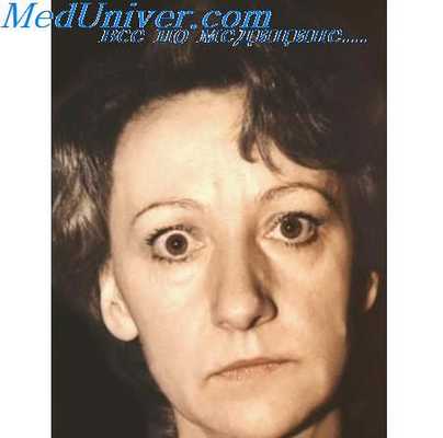 у женщины заболевание щитовидной железы