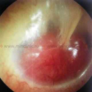 Гнойный отит или воспаление среднего уха. Сквозь барабанную перепонку просвечивается уровень воспалительной жидкости (гноя) красного цвета.