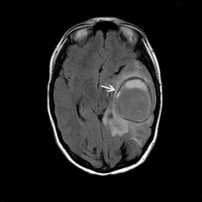МРТ головного мозга. Резко ограниченная овальная масса левой височной и теменной доли (отогенный абсцесс головного мозга, белая стрелка) после недавней операции на левом среднем ухе.