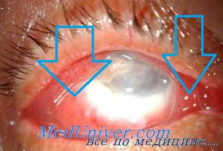 диагностика эндофтальмита