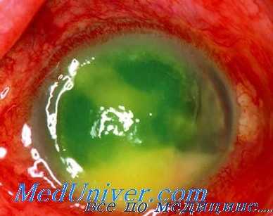 диагностика эндофтальмита