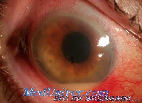 гнойный иридоциклит