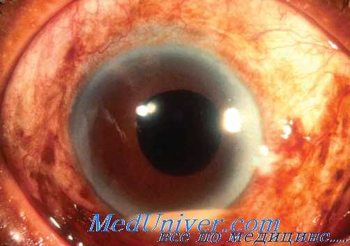 гнойный иридоциклит