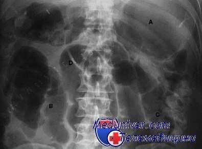 кишечная непроходимость