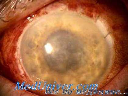 механизмы развития эндофтальмита