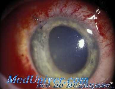 инфекция глаза при эндофтальмите