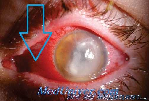 эндофтальмит