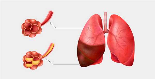 Острые инфекции нижних дыхательных путей