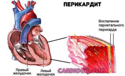 перикардит