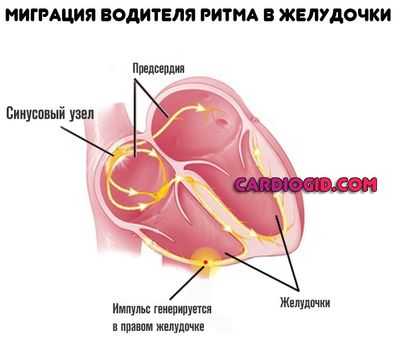 миграция водителя ритма в желудочки