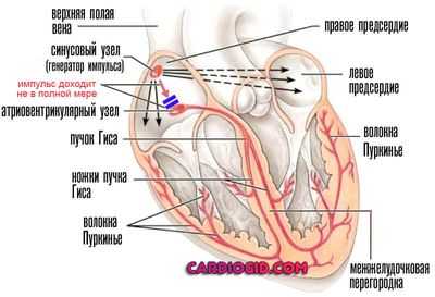 синдром слабости синусового узла