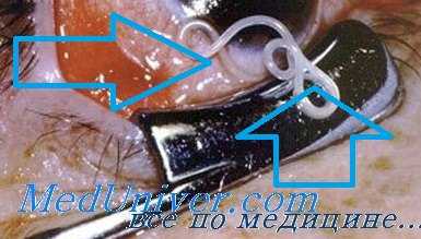 паразиты глаз человека