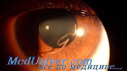 паразитарные болезни глаз