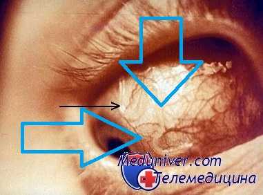 гельминтоз глаз - ларвальнос