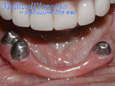 протезные стоматиты