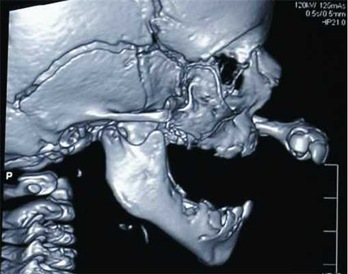 Рис. 1. КТ (боковая проекция). Диагноз: врожденная двусторонняя полная расщелина верхней губы и неба.