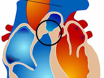 Фото Стеноз легочной артерии