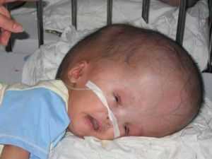 Гидроцефал