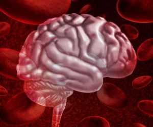 инсульт мозга