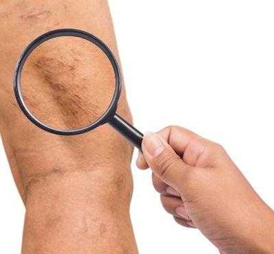 Foam-form склеротерапия