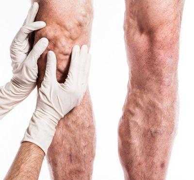 ЭХО-склеротерапия