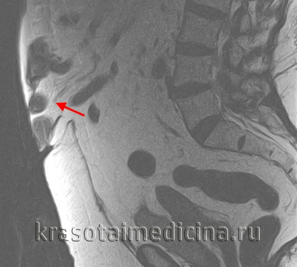 МРТ ОБП и забрюшинного пространства. Грыжа белой линии живота выше пупка (сальник, брыжейка, часть тонкой кишки)