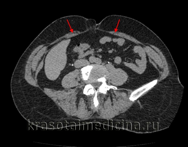 Грыжа белой линии живота