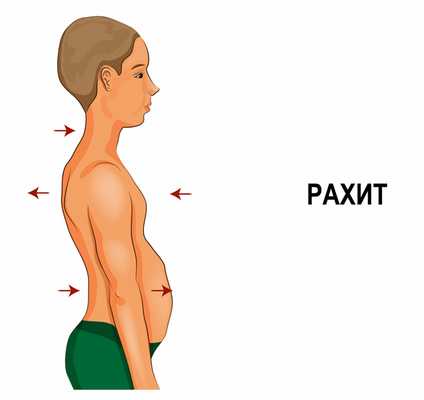 Рахит у ребенка.jpg