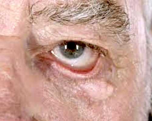 Атония века