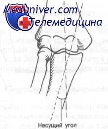 надмыщелковые разгибательные переломы плечевой кости