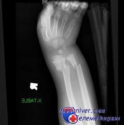 разгибательные переломы костей предплечья Коллиса