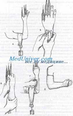 разгибательные переломы костей предплечья Коллиса