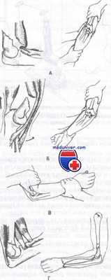 надмыщелковые разгибательные переломы плечевой кости