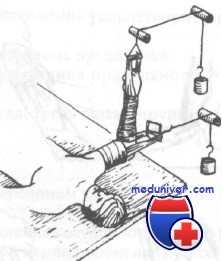 надмыщелковые разгибательные переломы плечевой кости