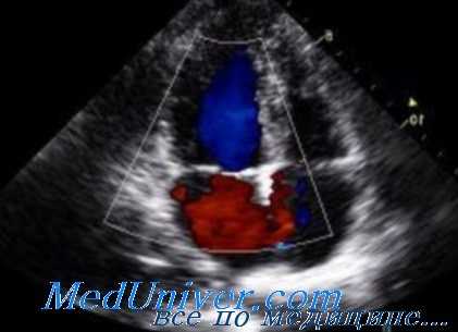 эхокардиография
