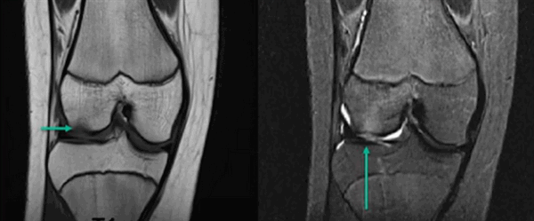 Субхондральный перелом латерального мыщелка на МРТ