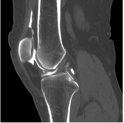 Компьютерная томограмма коленного сустава (сагиттальная проекция)