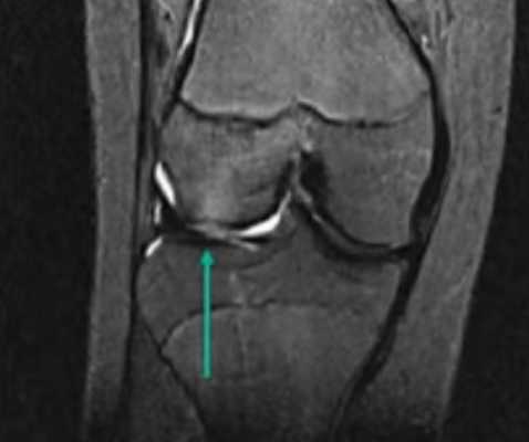 Расшифровка МРТ коленного сустава