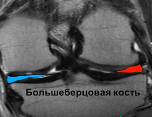 Коленный сустав в норме на МРТ